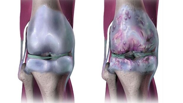 Здрав колен зглоб и под влијание на артроза