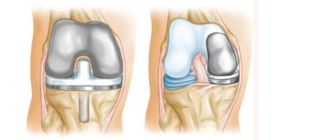 артропластика за артроза на колен зглоб