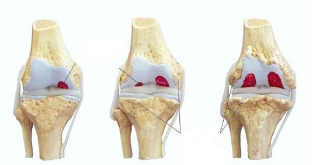 фази на артроза на колен зглоб