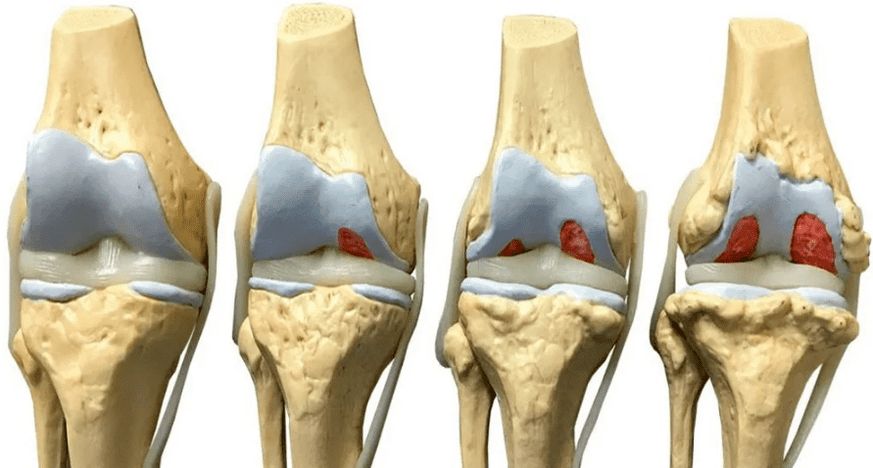 оштетување на коленото зглоб во различни фази на развој на артроза