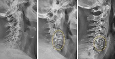 слики на цервикалниот 'рбет за дијагноза