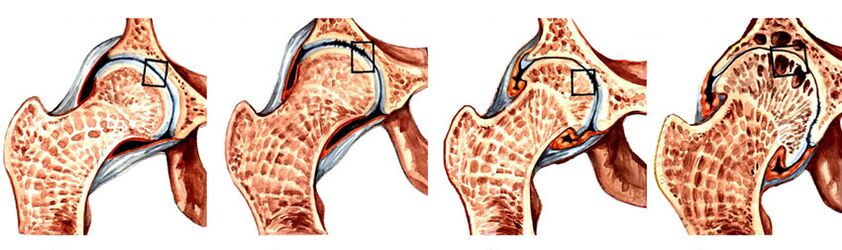 Степенот на развој на артроза на зглобот на колкот