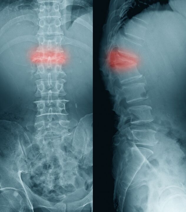 дијагноза на болки во грбот