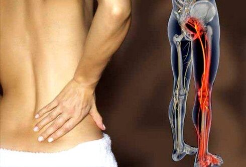 болка во долниот дел на грбот поради воспаление на ијатичниот нерв
