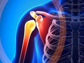 Воспален рамо зглоб поради артроза - хронична болест на мускулно-скелетниот систем