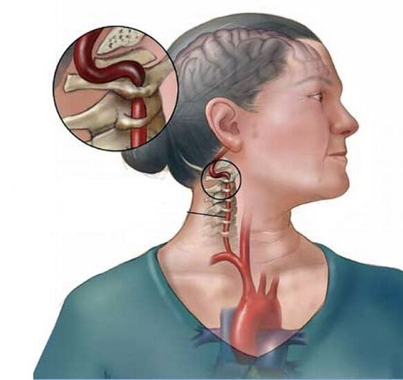синдром на вертебрална артерија со цервикална остеохондроза