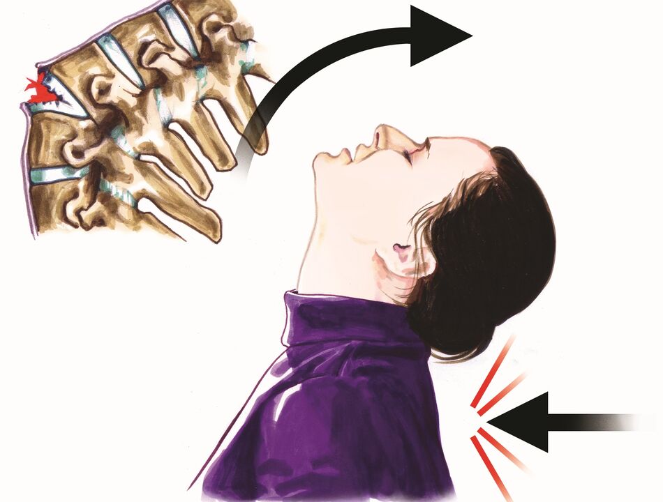 оштетување на 'рбетот како причина за болка во вратот